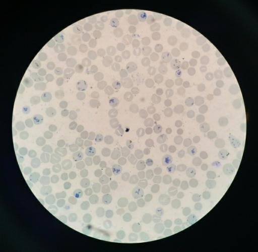 煌焦油蓝染色,镜下可见大量网织红细胞.