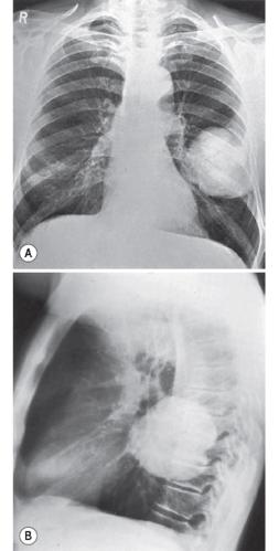 "尾征"可能代表继发于肿块外支气管阻塞引起的盘状肺不张或淋巴回流