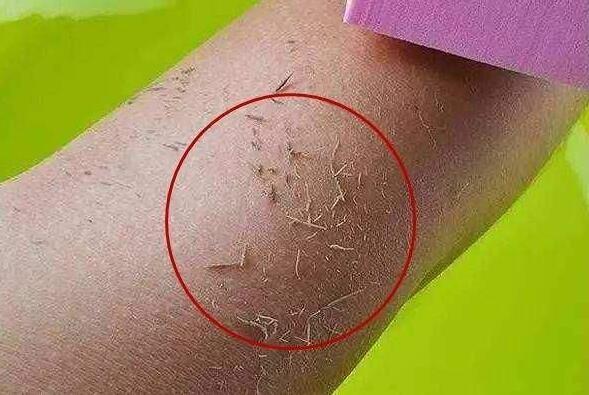 鼻子上挤出来的白色条状物,到底是螨虫还是粉刺?一起来了解一下