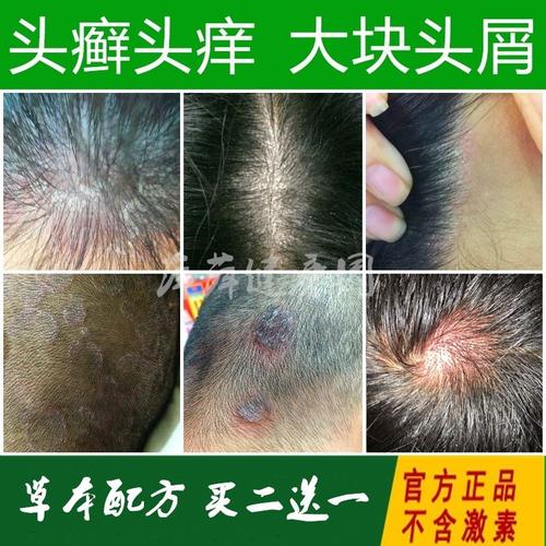 治头皮癣药膏头部藓去大块头皮屑痒洗发水癣的药