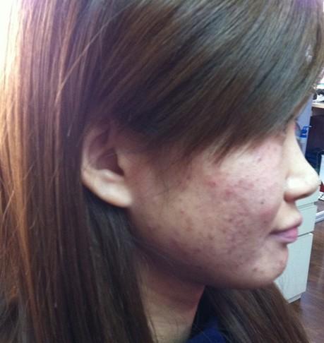 皮肤过敏的症状,怎么处理?我脸部皮肤长出了水泡,还总是发痒和脱皮.