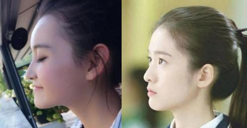 梁小冰就属于鼻基底 鼻子 颧骨整体面中低平凹陷而出现的假性反颌