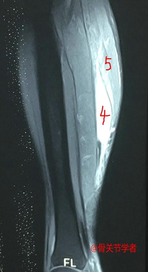 第二天患者查的磁共振结果也出来了,患者内侧腓肠肌撕裂,腓肠肌内侧