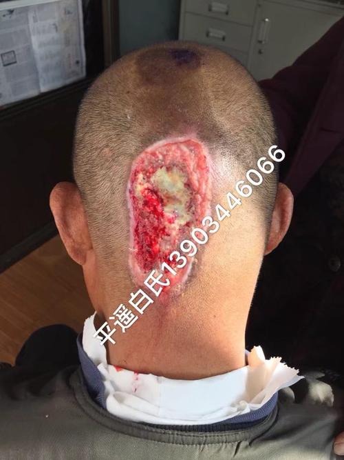 头部溃烂露骨治愈案例