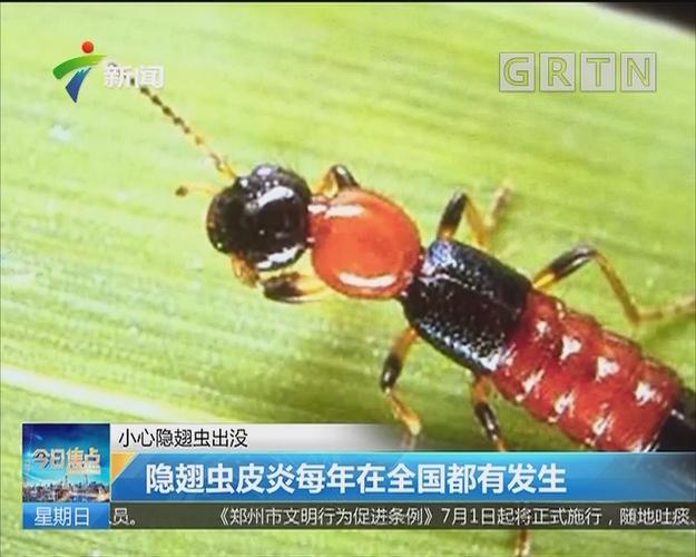 小心隐翅虫出没:公园回来孩子几乎毁容 隐翅虫惹的祸