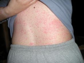 药物过敏症状都是什么药物过敏怎么办