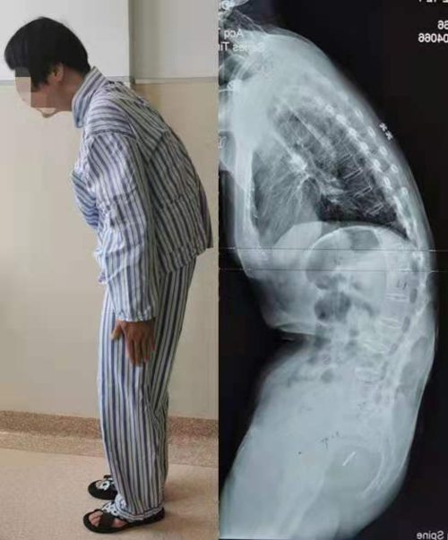 告别十年罗锅昂首挺胸迎来新生