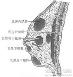 得了急性乳房炎该怎么办?