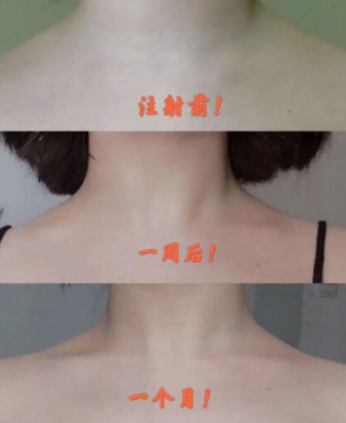 没有锁骨的,说不定一下就 收获了从未谋面的这块骨头,可以让肩膀看