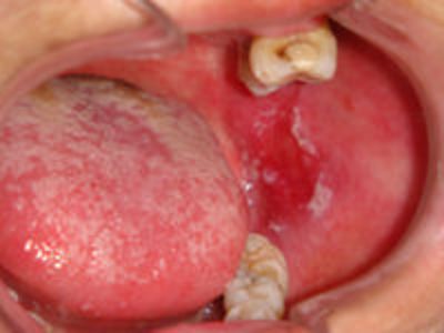 口腔扁平苔藓治疗方法