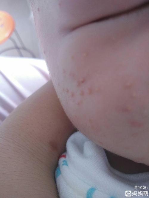 宝宝36天了,脸上长了好多这样的痘痘,而