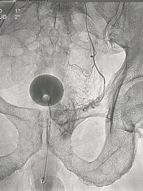 左侧前列腺动脉栓塞术后,造影复查示:左侧前列腺动脉主干闭塞.