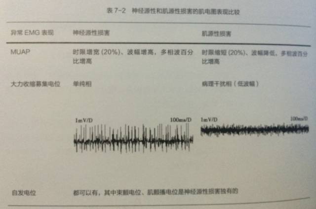 如何读懂肌电图,收藏!