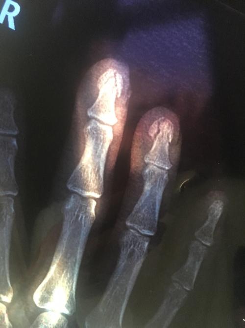这样的手指骨折是不是上夹板就可以了?