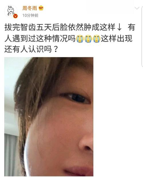 周冬雨拔智齿,五天后脸仍然肿成包子,评论区一片笑声