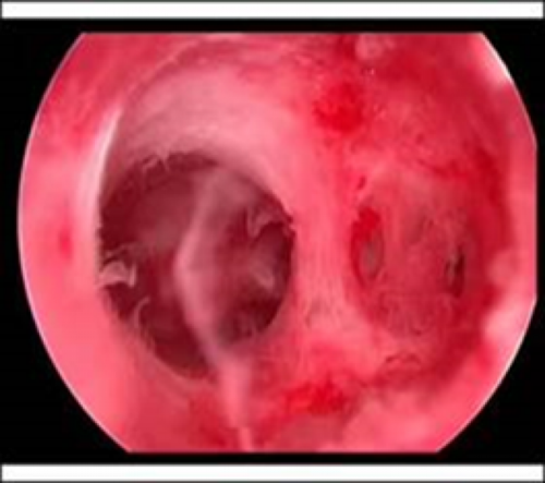 宫腔疾病之宫腔粘连