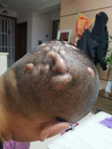 头部严重毛囊炎,求中医解决办法.