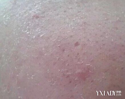 图脸上起皮怎么办4个秘诀帮你恢复水润肌肤