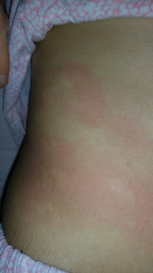 病还是过敏,白天什么都没有一点也不痒,到了晚上回到家脱了衣服就这样