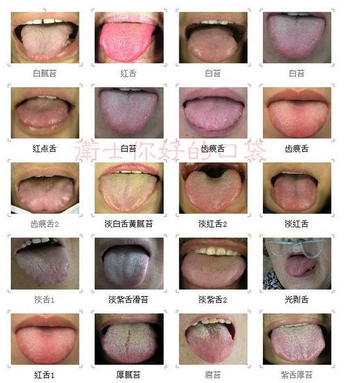 舌苔图象及辨病