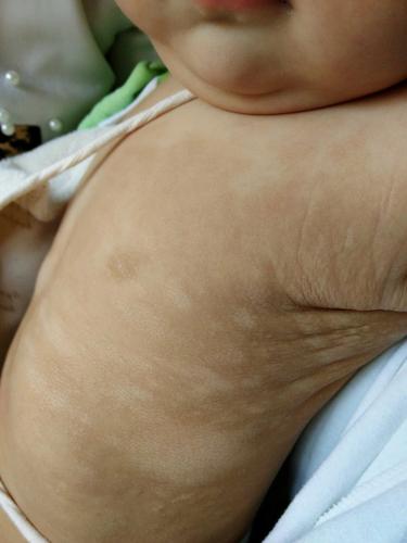 九个月宝宝,白色糠疹!急啊