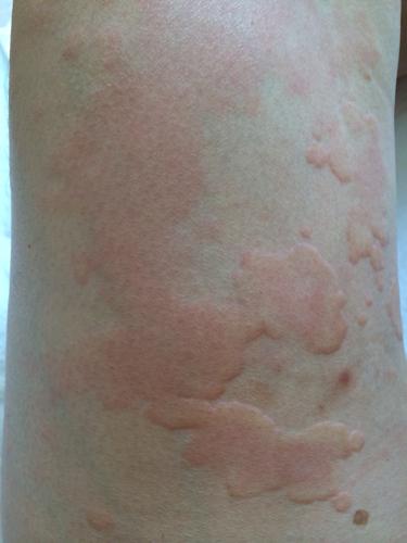 喝酒后一天皮肤成这样了,身体体检过敏源等各项指标都正常