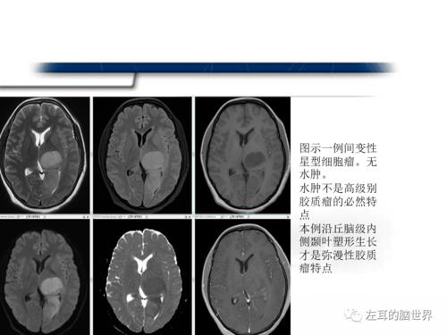 血脑屏障,强化,水肿影像诊断_常读_微信_平台