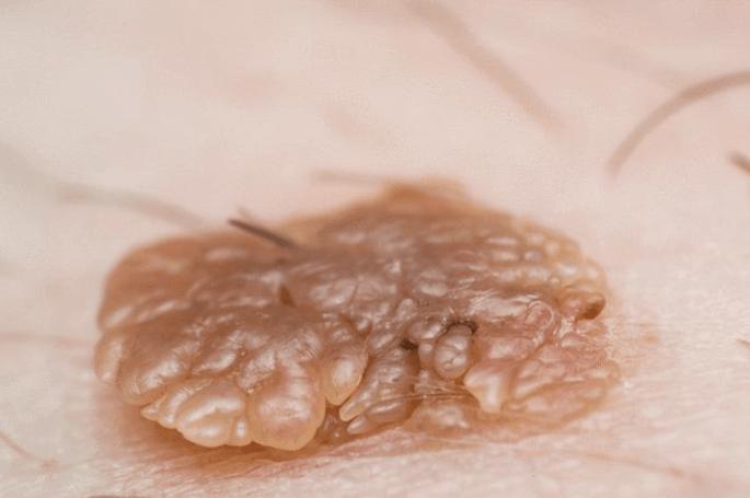 如果出现尖锐湿疣,建议直接就医做hpv和tct检查,防止宫颈病变.