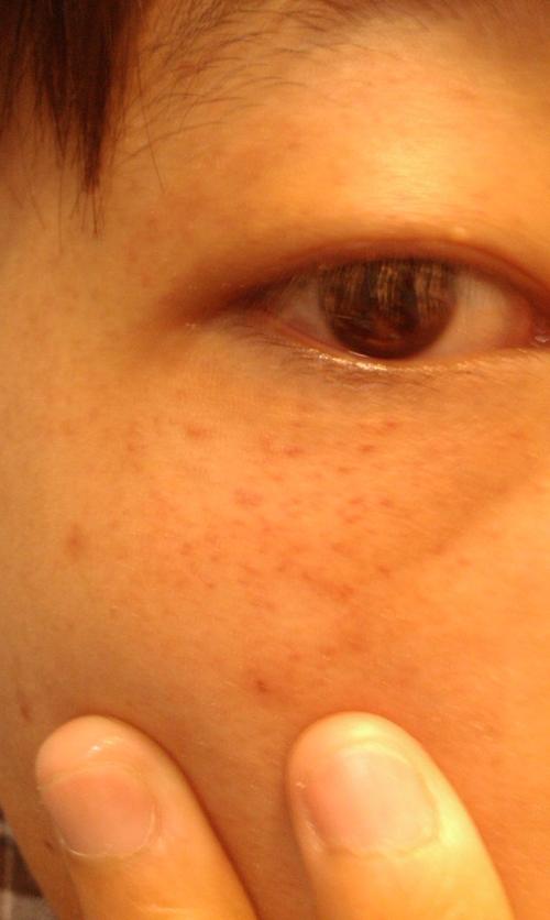 眼睛边上长了很多小红点