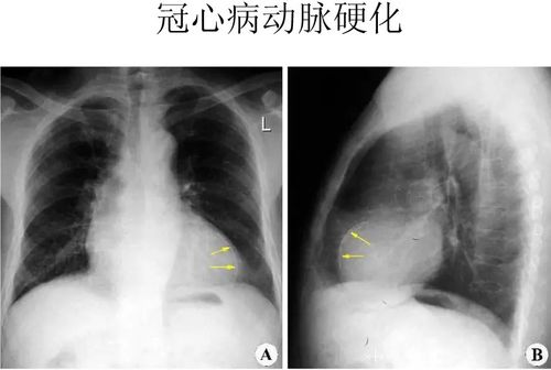 心脏x线表现
