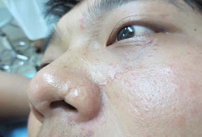 面部红血丝的出现原因有很多,主要是由于毛细血管扩张而形成的