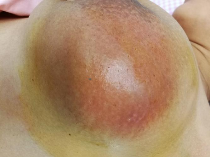 哺乳期乳腺脓肿的治疗