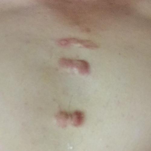 胸口长了这疙瘩是什么鬼几年了不疼不痒好像越来越多