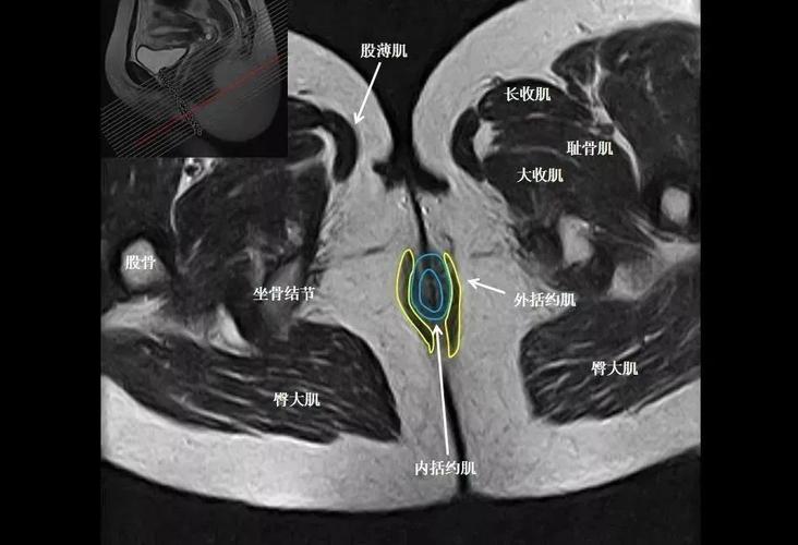 张8图带你熟悉盆底mri解剖