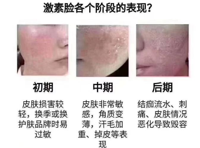 激素脸有哪些症状 激素脸排毒的6个过程