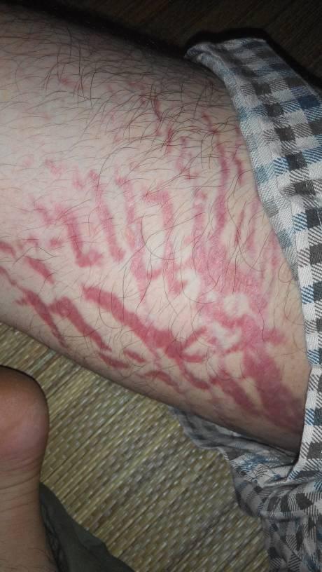 腿上膨胀纹会越来越多吗?这是不是膨胀纹膨胀纹又用什么药可以治疗