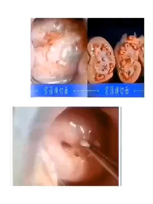 宫颈囊肿的处理细节_医疗健康_医疗健康其他