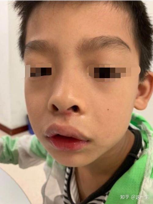 鼻炎,腺样体肥大导致睡觉鼻塞,张嘴呼吸影响颜值,如何