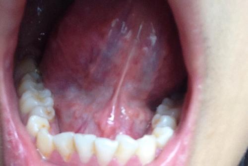 舌头下面长了很多小肉粒是什么