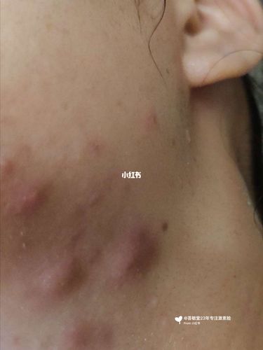 下颌部位是结节或者囊肿性痤疮的好发部位,由于痤疮的