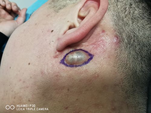 耳后囊肿切除术