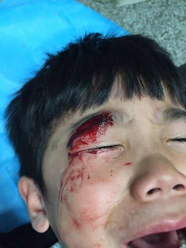 儿子7岁,11月7日晚上眉毛磕破缝针,当时太着急,慌了就