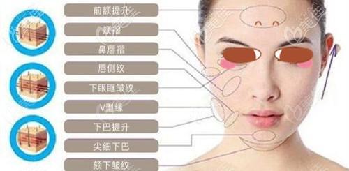 壹加壹"宫格拉提"术采用ppdo线,同时改善上中下面部的松弛皱纹