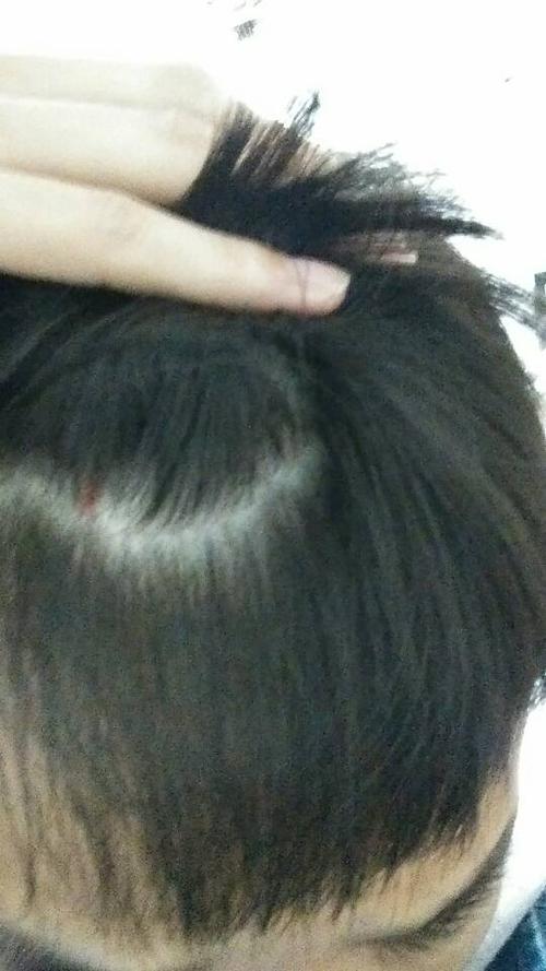 头撞了一下,有个很小的包,破了点儿皮,但没流血,怎么办