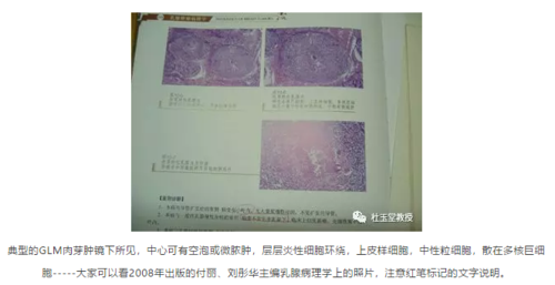 注意肉芽肿的病理形态并非glm所独有,浆乳(pcm)也常伴有肉芽肿形成