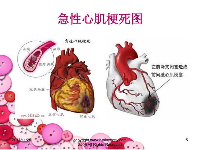 急性心肌梗死病人的护理ppt