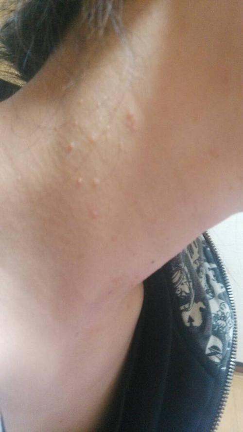 脖子上长了好多痘痘开始就几个现在传了好多有点像粉刺特别痒.
