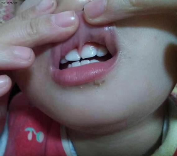 孩子唇系带历险记
