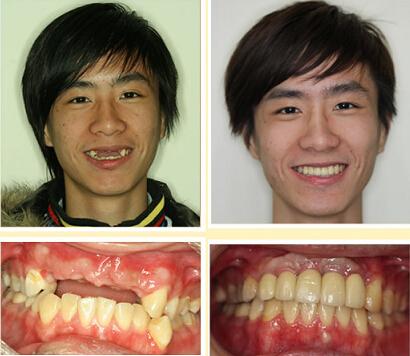 拜博种植牙真人案例