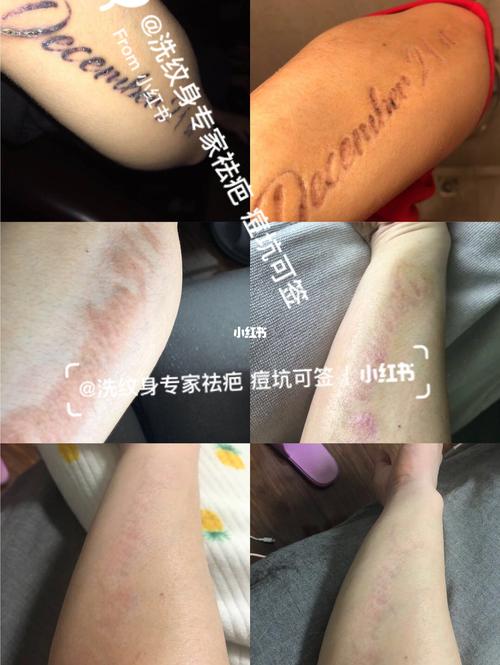 洗纹身记录恢复_纹身_洗纹身_美妆_彩妆